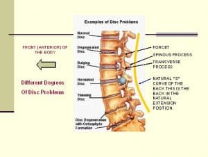 Disc and lower back issues that can cause pain and debilitating issues